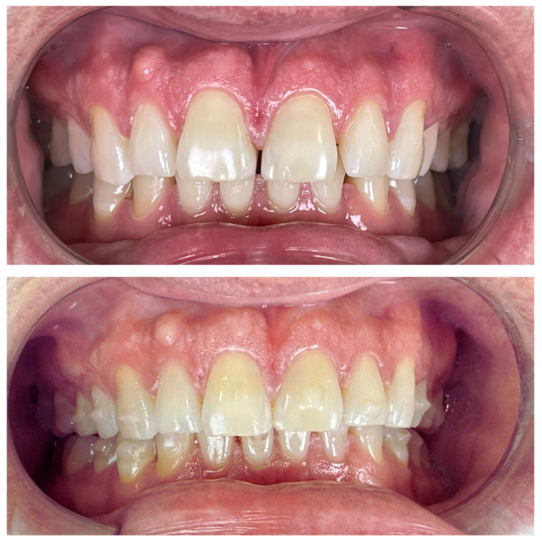 Clear Aligners