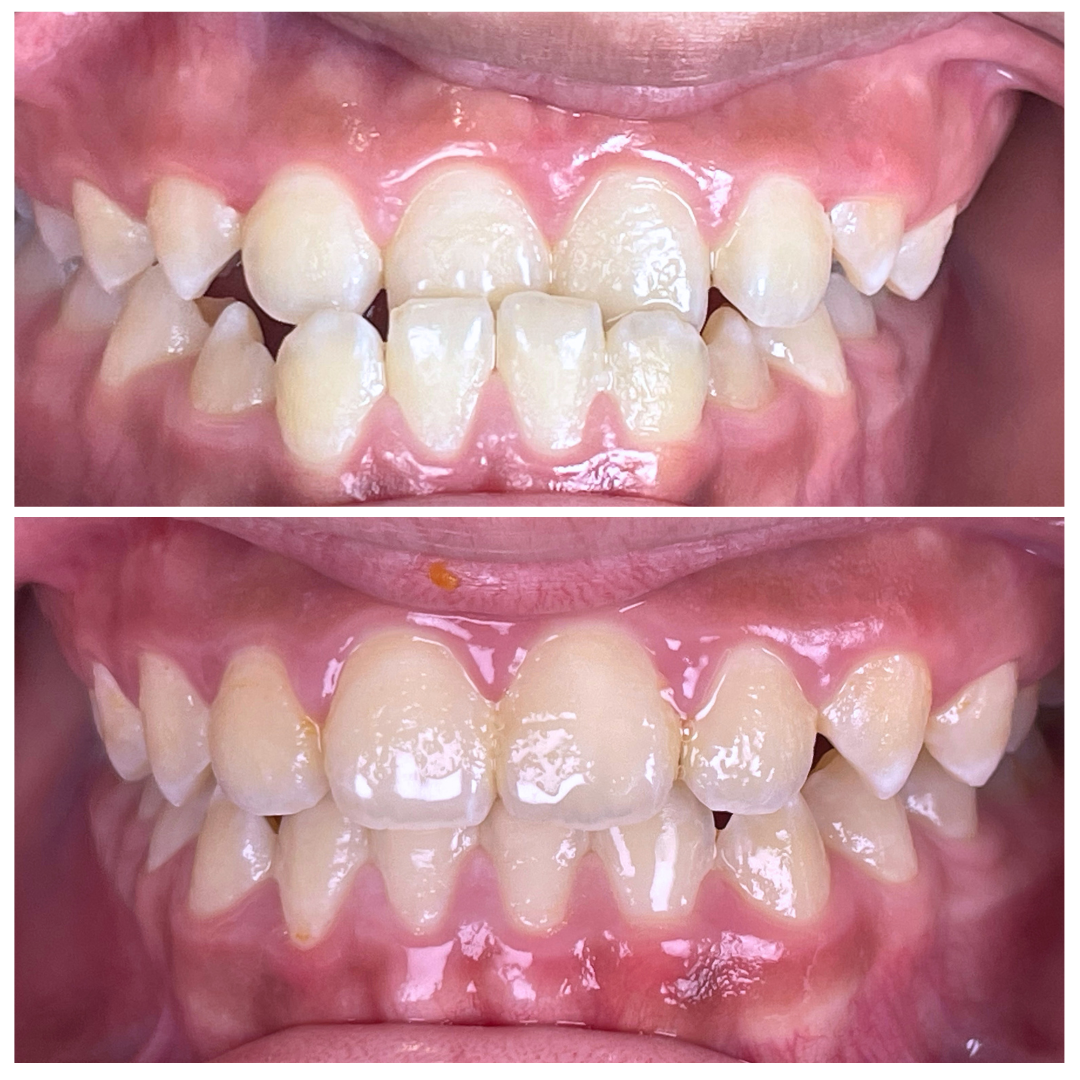 Early Orthodontic Intervention